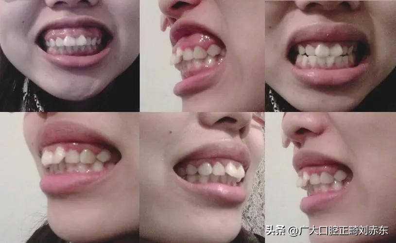 正畸后变形怎么处理,龅牙正畸前后对比图片
