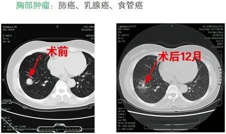 运城肿瘤专家卫毅楠教授开展新一代125-碘粒子植入术肿瘤精准治疗
