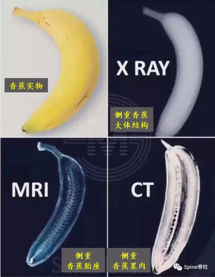 腰椎间盘突出症的治疗方法,腰椎间盘突出症状主要有哪些