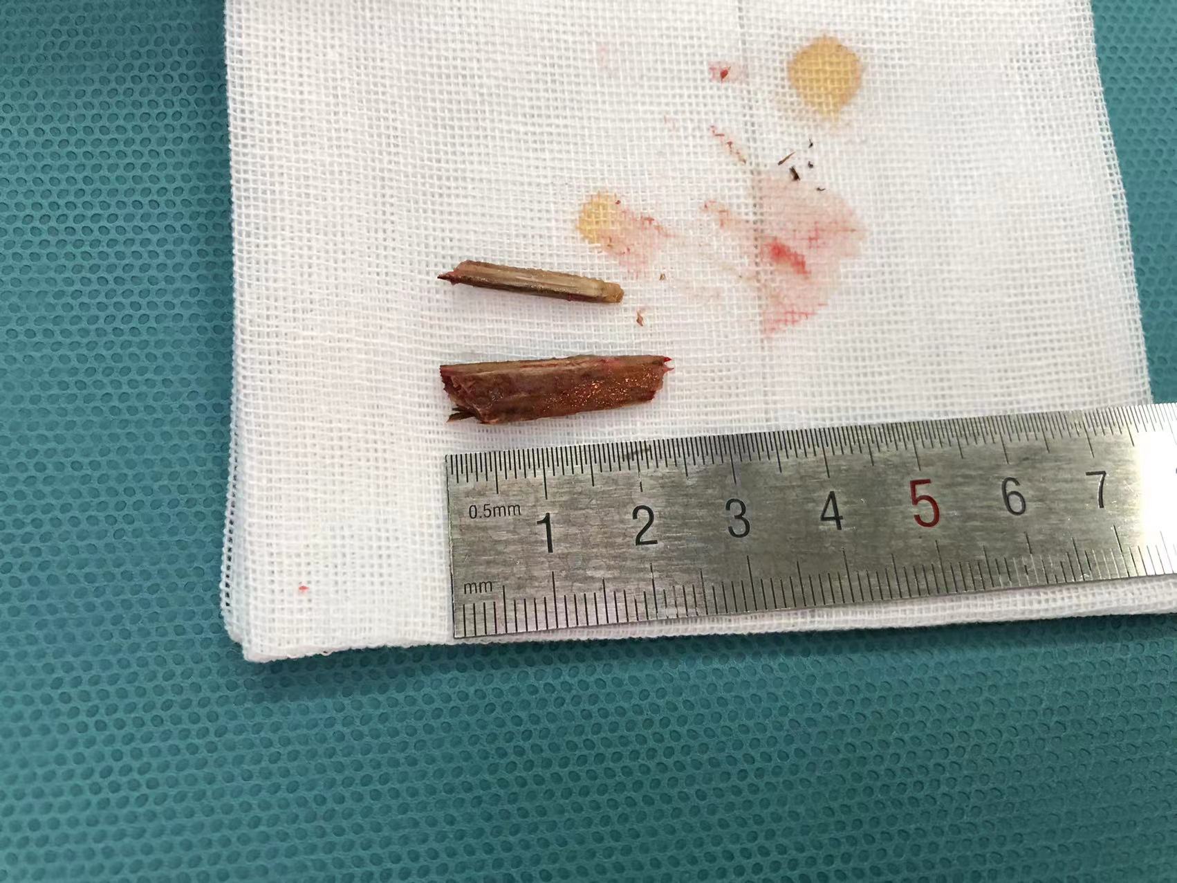 老人摔跤伤口化脓,女孩摔跤导致右眼皮受伤留下疤痕