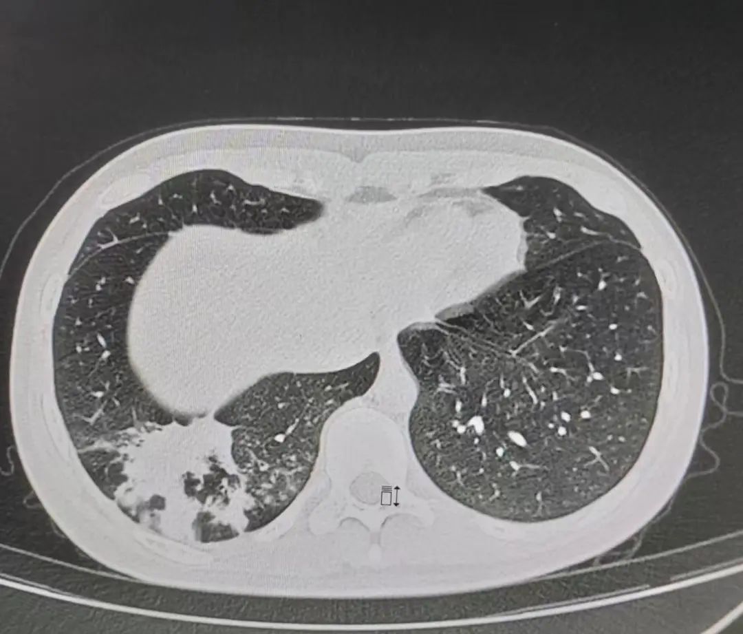 16岁支原体肺炎1-7天表现症状图,儿童确诊支原体肺炎怎么治疗