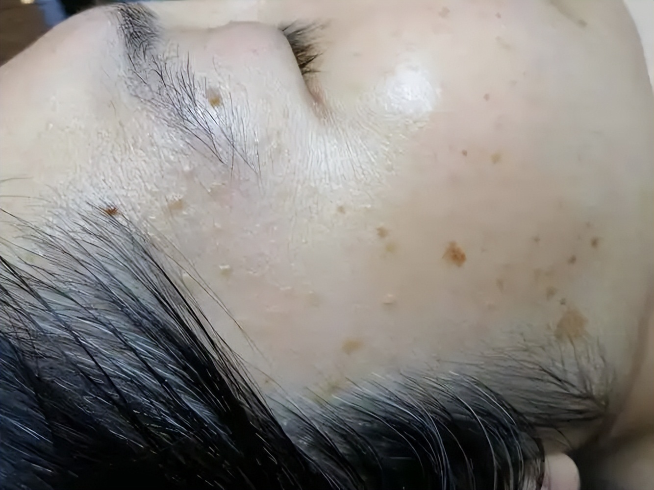 脖子和腋下总长“小肉粒”？可以用手揪吗？医生：与7种疾病有关