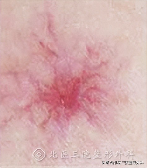 如何改善面部泛红肤色暗沉,面部三角区泛红是什么原因