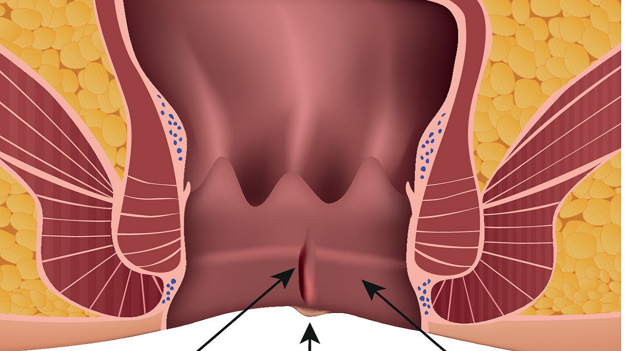 女性哪些生活习惯会引发肛裂,18岁女孩肛裂是什么毛病引起的