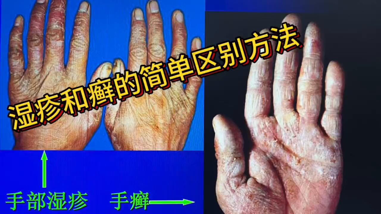 肛周湿疹和肛周癣的区别,手指癣和湿疹的区别