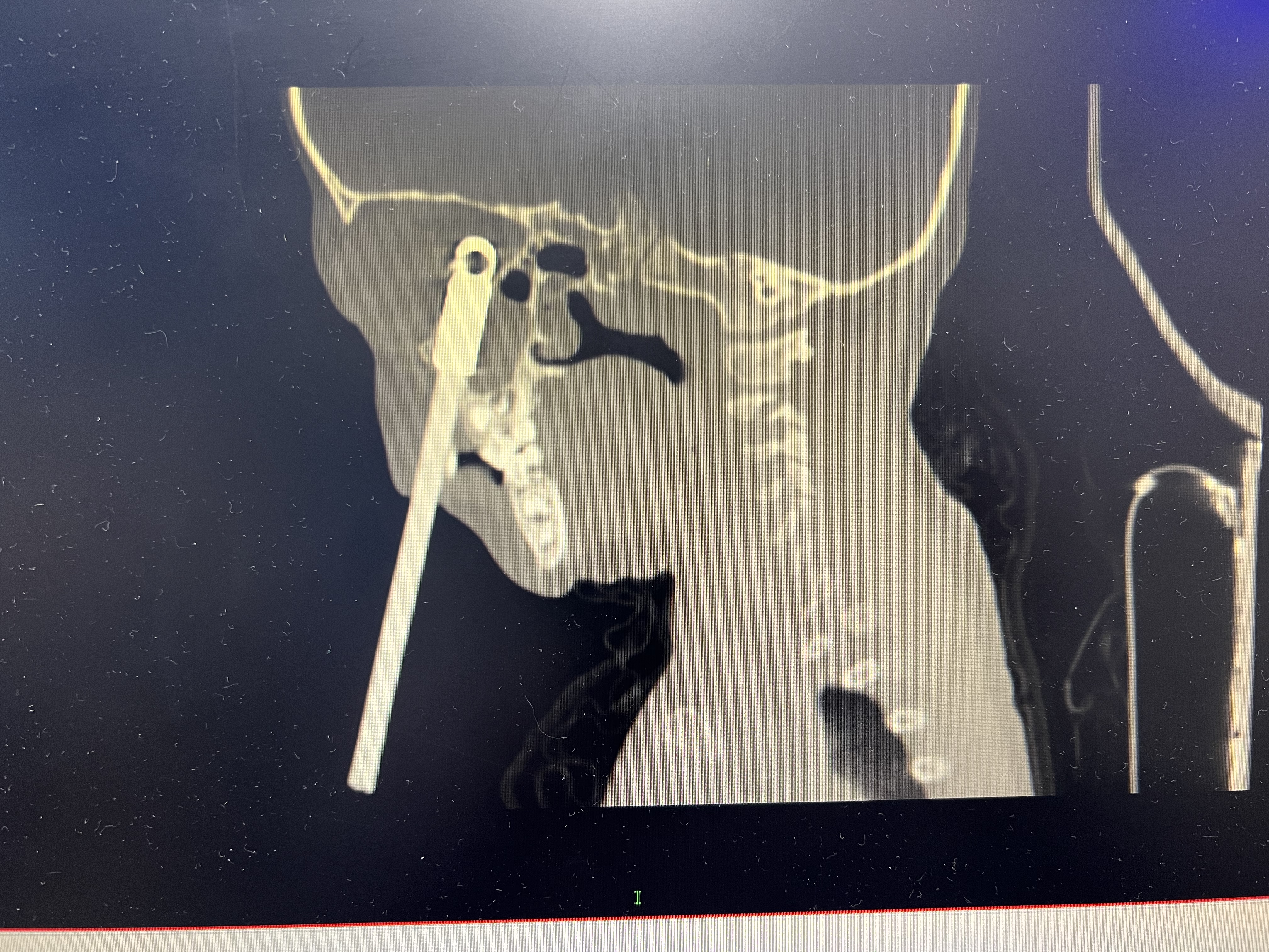 4岁男孩眼睛被20公分刺穿,11岁男孩眼睛被塑料棍戳到眼睛
