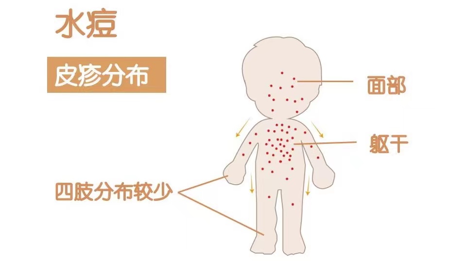 带状疱疹生蛇疼起来要人命,带状疱疹会要人命吗
