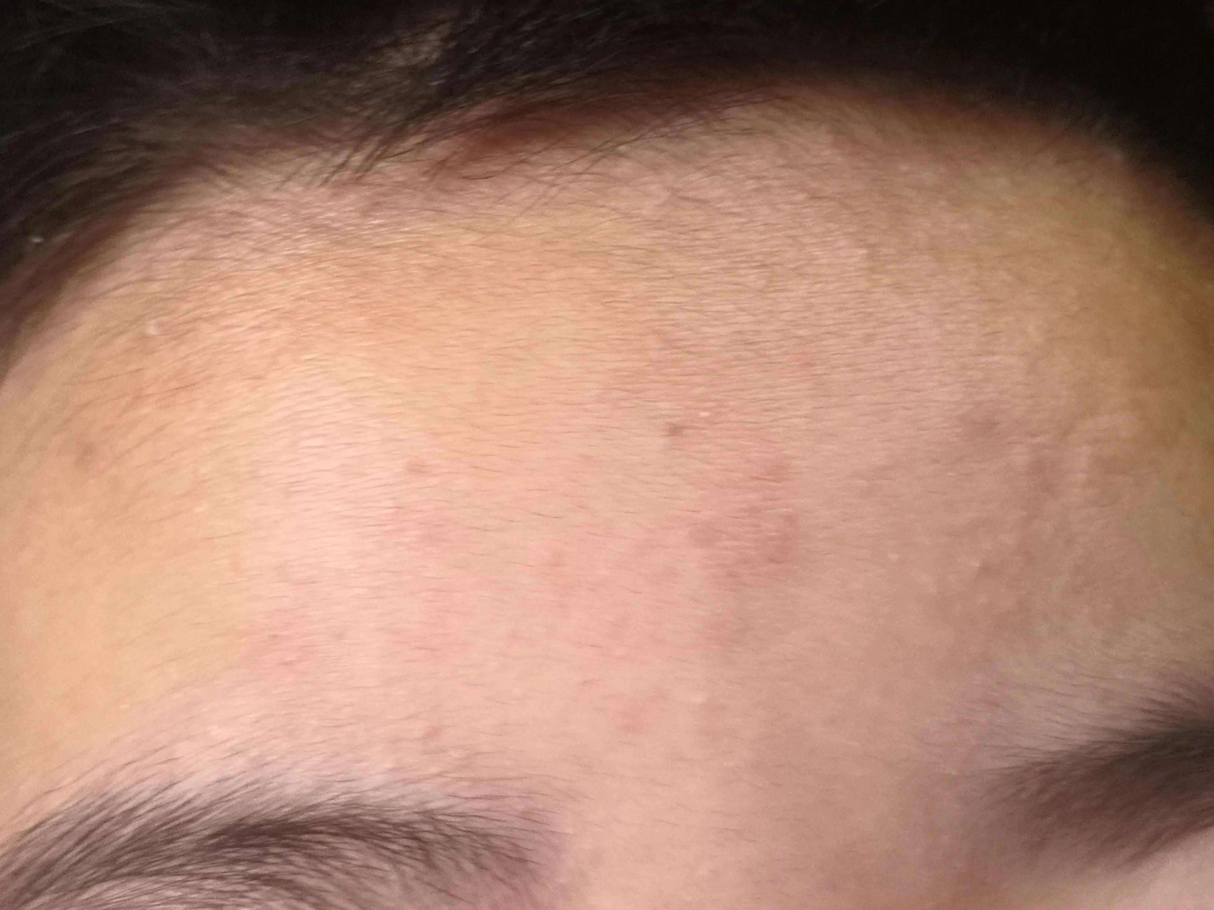 适合青春期长痘的面霜 (青春期爆痘用什么面霜)