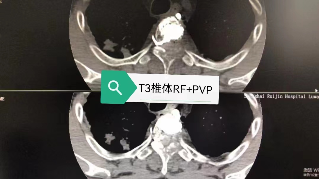 病例Ⅴ：RF+PVP联合治疗高位胸椎溶骨性转移瘤及压缩骨折