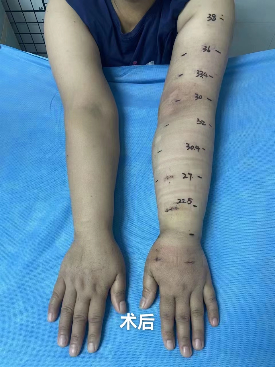 桂北首例|南溪山医院超显微手术成功治疗上肢淋巴水肿