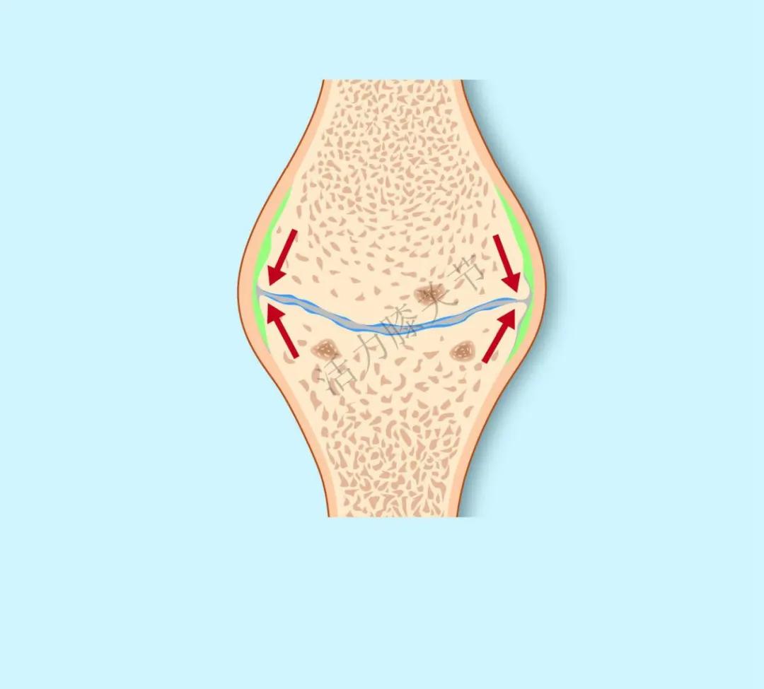 骨关节炎是如何产生的,骨关节炎的形成机制