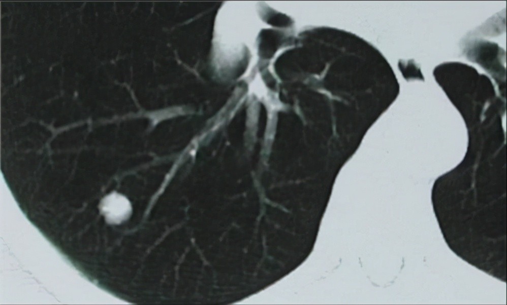体检发现肺实性小结节,体检发现肺小结节无需过度紧张