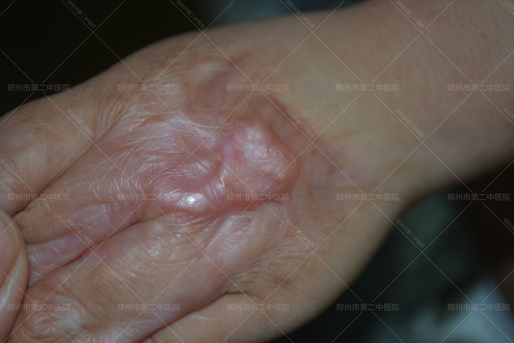 郑州市哪家治疗疤痕最好,郑州市第二中医院治疤痕