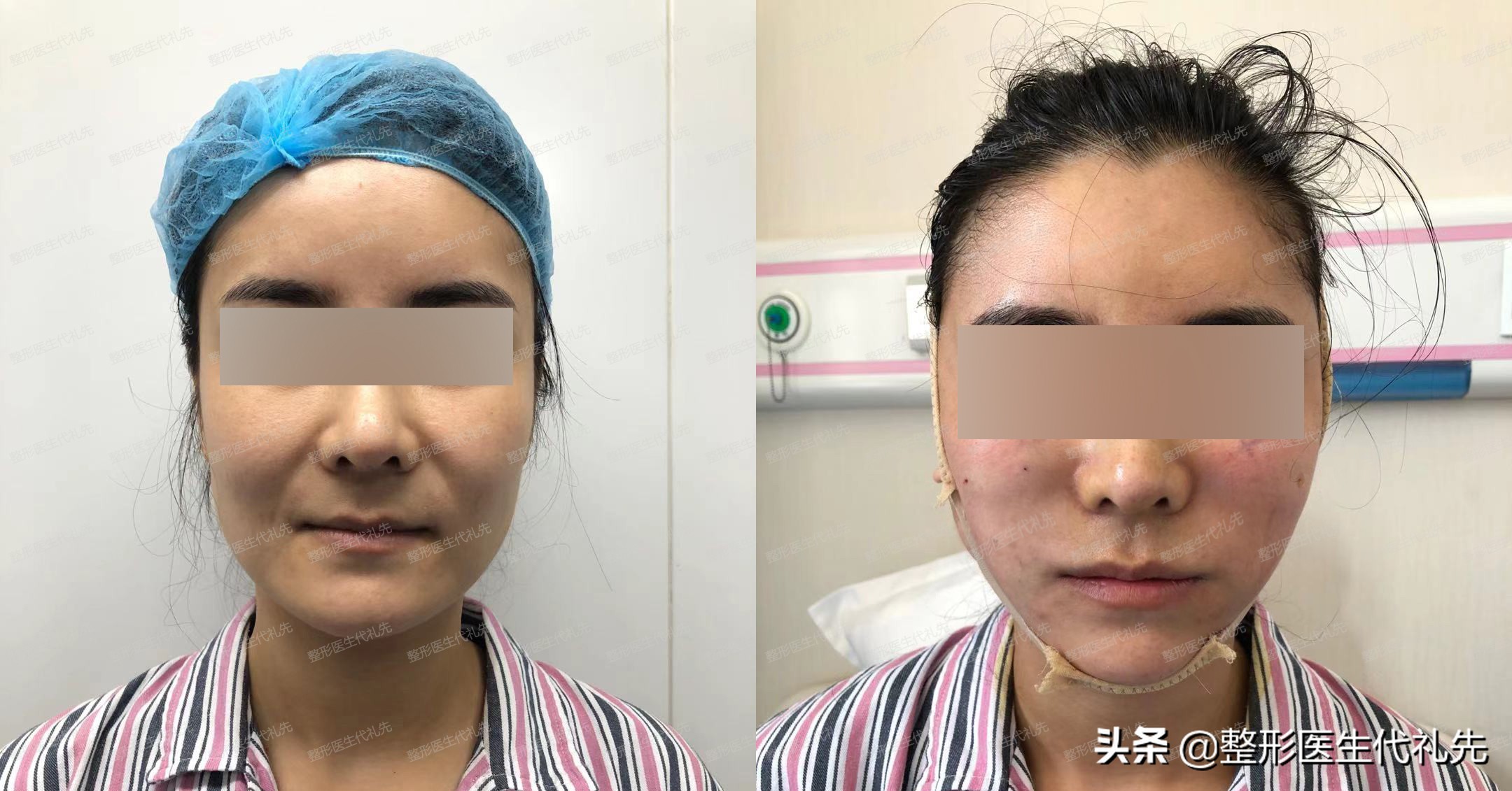 去法令纹现在最有效的方法是什么,去除法令纹的最有效的方法是什么