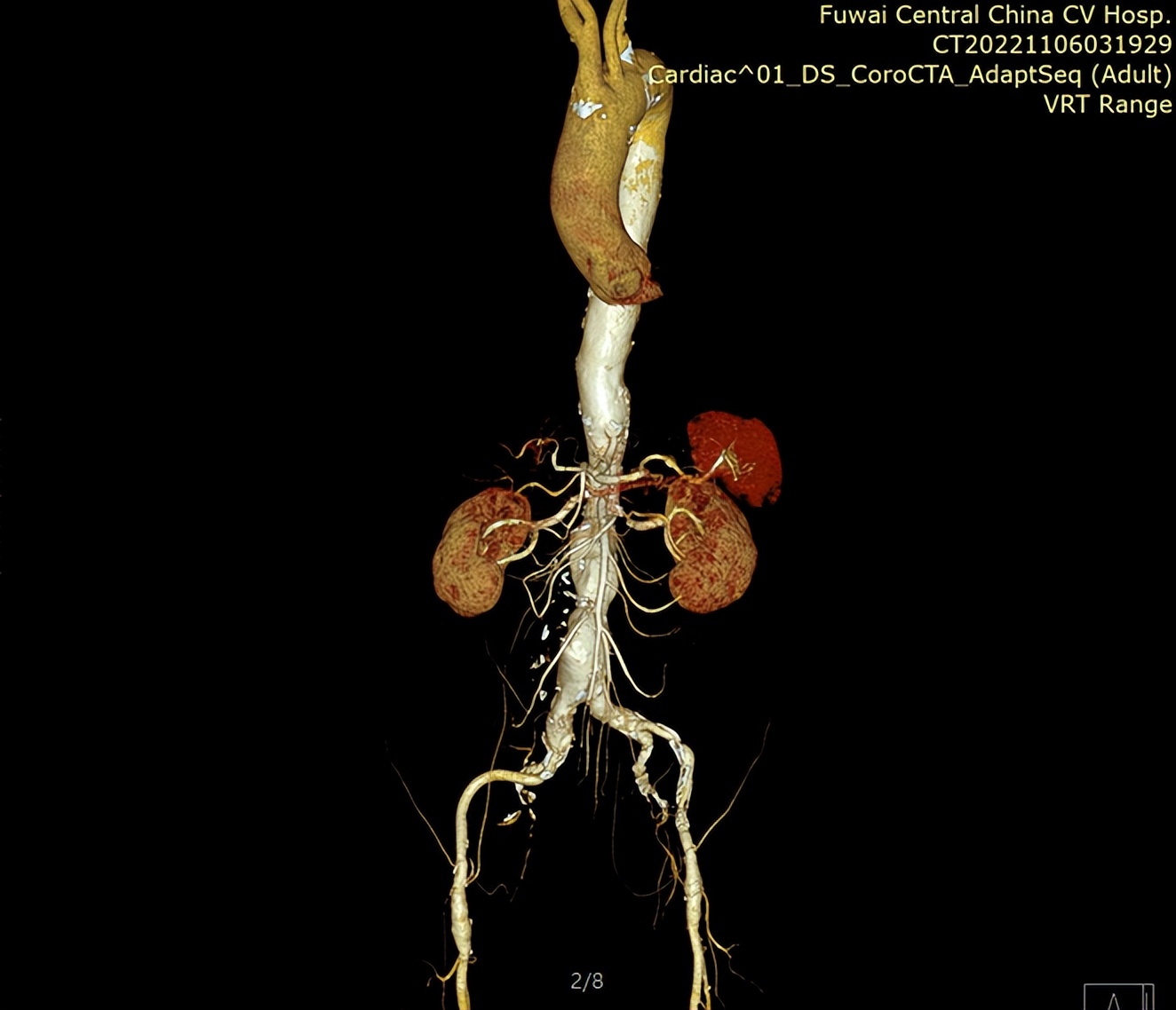 医学专家巧变“工艺师”，妙手缝制支架成功拆除主动脉“*弹炸**”