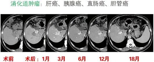 运城肿瘤专家卫毅楠教授开展新一代125-碘粒子植入术肿瘤精准治疗