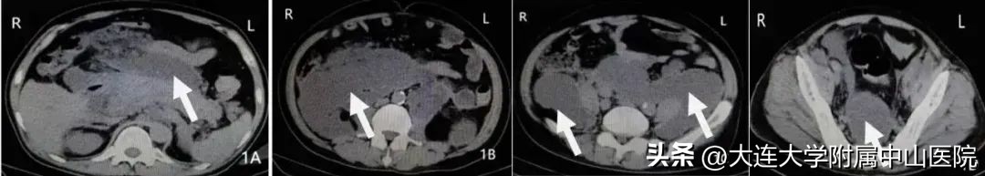 【案例回放】重症急性胰腺炎继发盲肠瘘危及生命，微创手术化险为夷