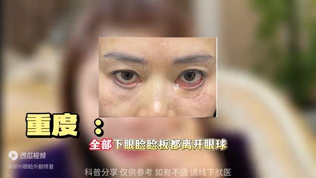下眼睑外翻修复前后图片,下眼睑外翻是什么样子