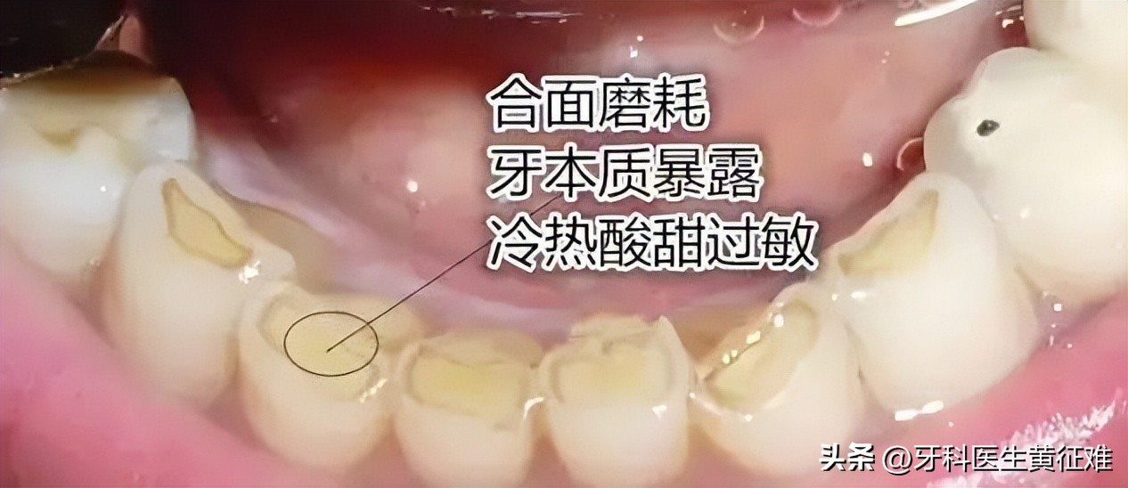 牙齿松动酸痛的原因是什么,牙齿咬起来酸痛是什么原因