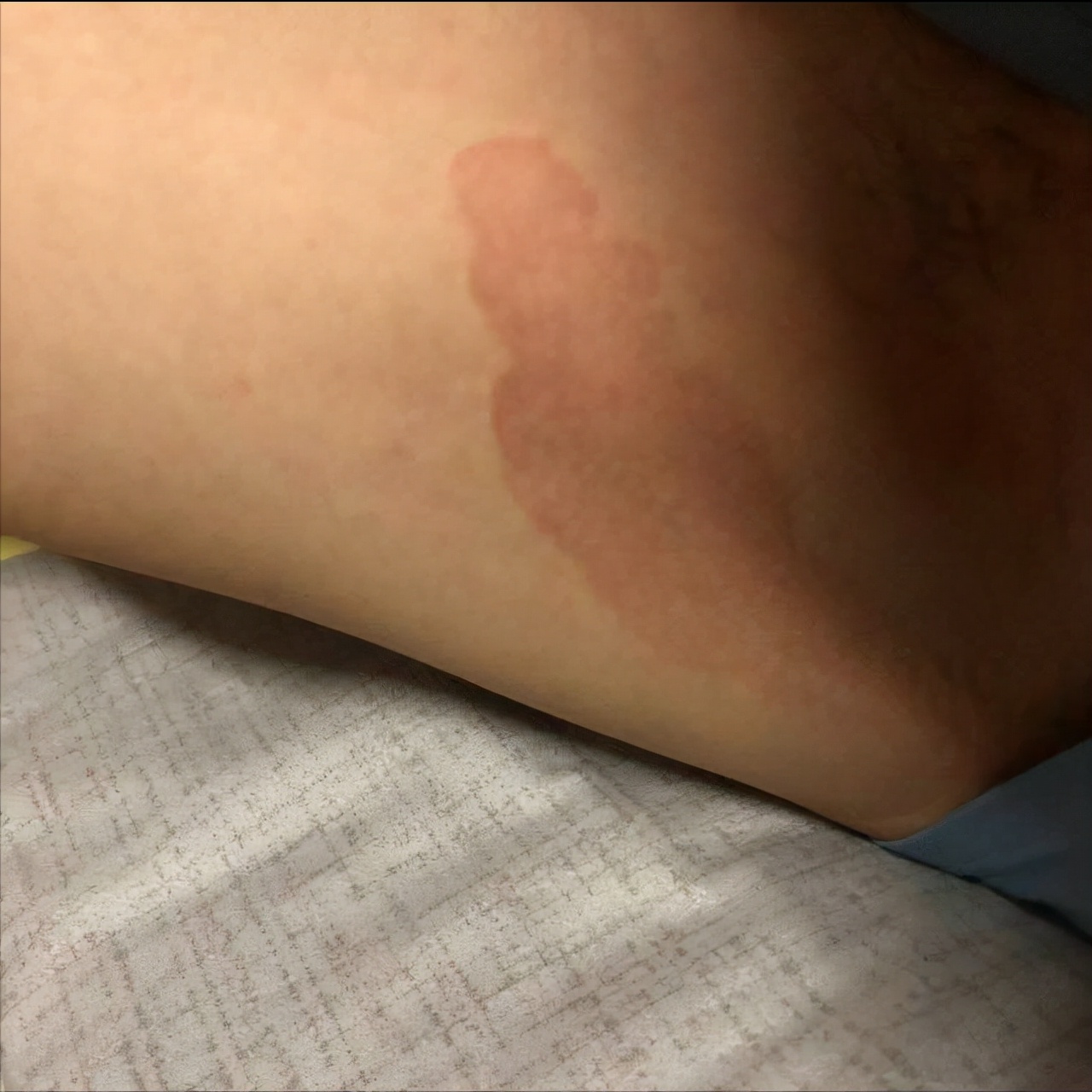 大腿内侧股癣和红癣区别,不知道自己得了股癣还是红癣