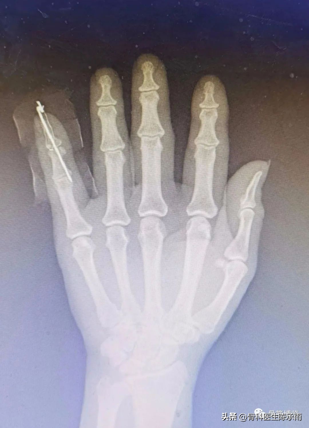 手指出现锤状畸形不要太紧张，看后知道伸肌腱止点断裂重建术