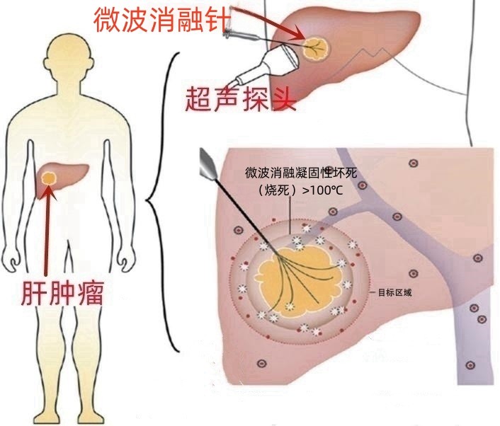 晚期肝癌如何轻松无瘤生活5年？微波消融助力完全“烧死”肿瘤