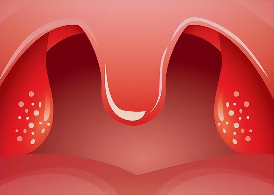 用药指导：扁桃体发炎，吃阿莫西林管用吗？