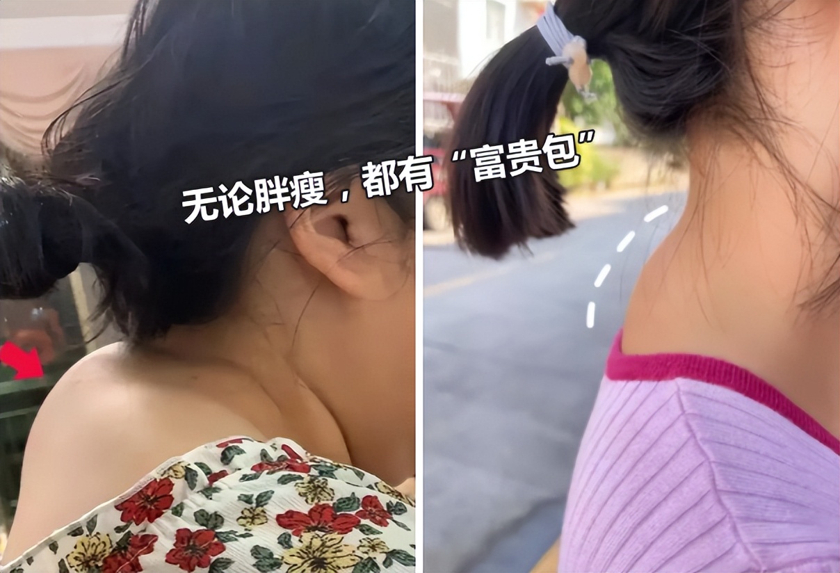 富贵包真的很丑吗,有富贵包会影响寿命吗