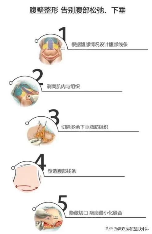 腹壁整形需要咨询问题,腹壁整形术亲身经历分享