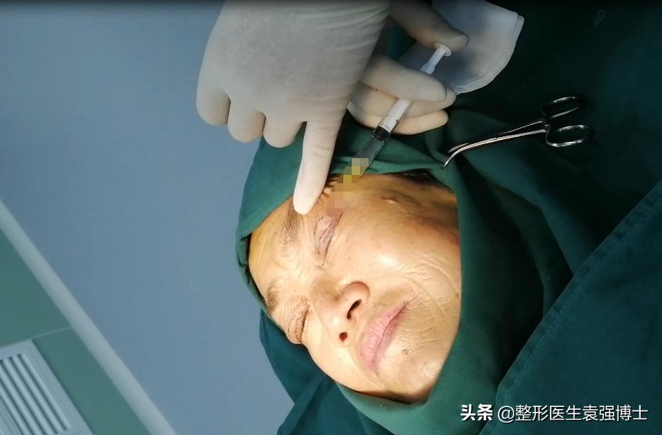 做完提眉和眼袋该注意些什么,做完提眉出现褶皱