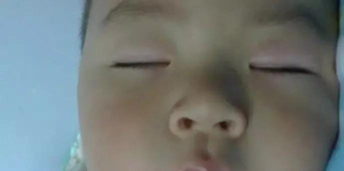 吃了退烧药过敏起皮疹严重吗,吃退烧药过敏还能吃吗