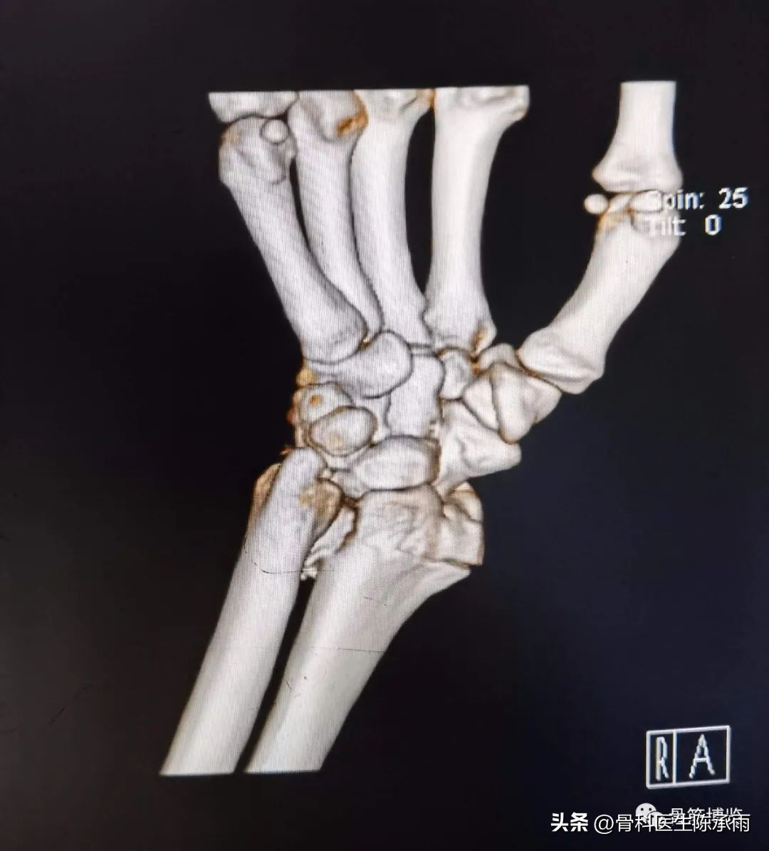 桡骨远端骨折伸直型的复位及固定,掌骨骨折外固定支架恢复