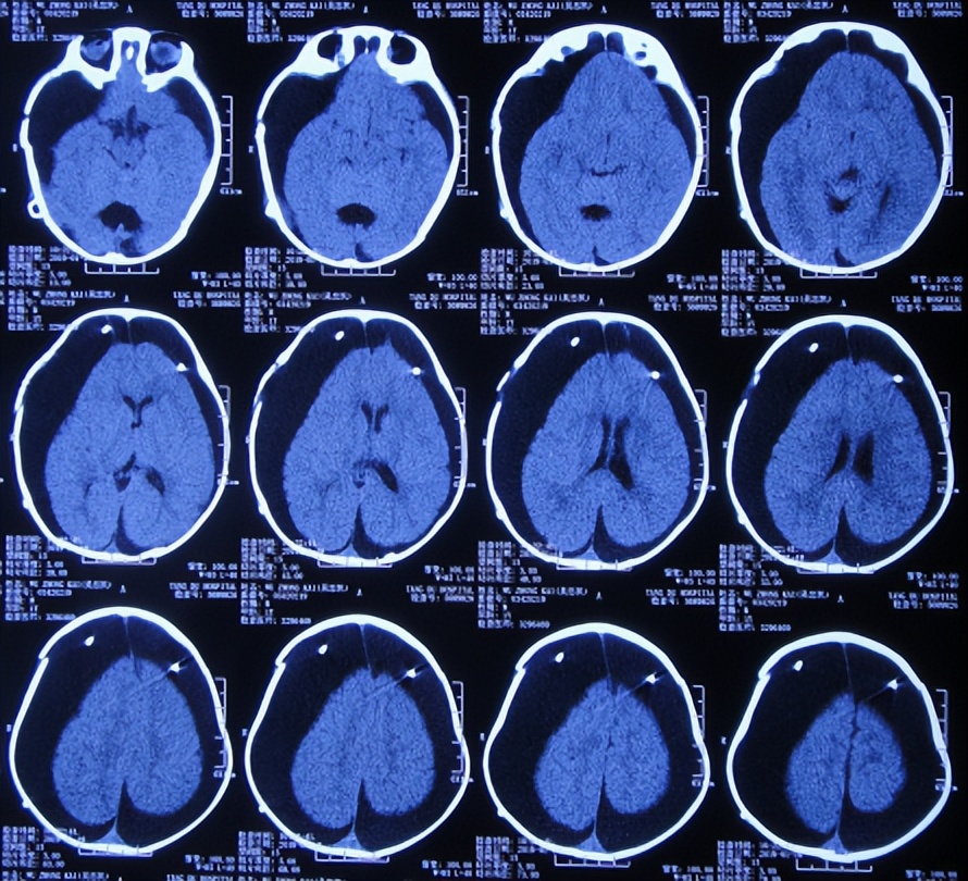 蛛网膜囊肿合并脑积水腹腔分流术,治疗蛛网膜囊肿引起脑积水严重吗