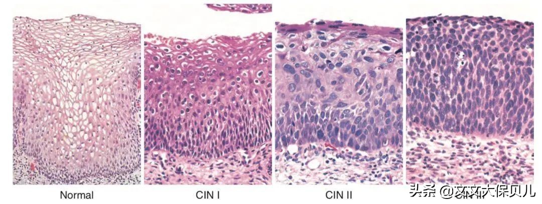 cin2-3累及腺体是宫颈癌吗,cin3级并累及腺体到宫颈癌多久