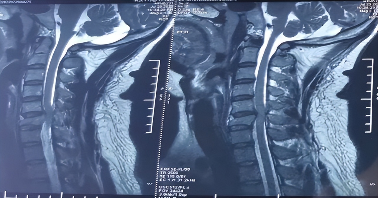120紧急救援落石砸伤男子,紧急救援男人被电梯压死