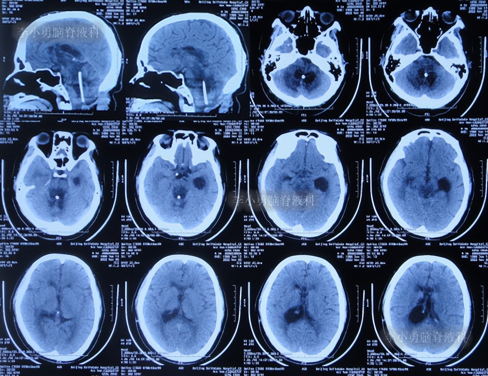 脑积水三脑室造瘘多久能恢复,脑囊虫手术后脑积水