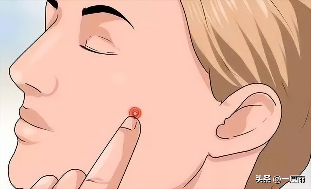 祛痘痘最快的方法不留痘印,怎么祛痘痘和痘印最有效的方法