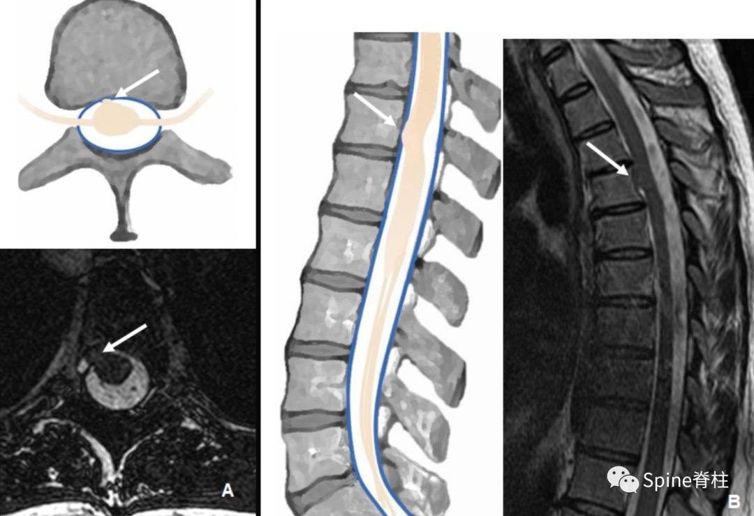腰椎椎管有囊性结构,水平椎管内囊性占位