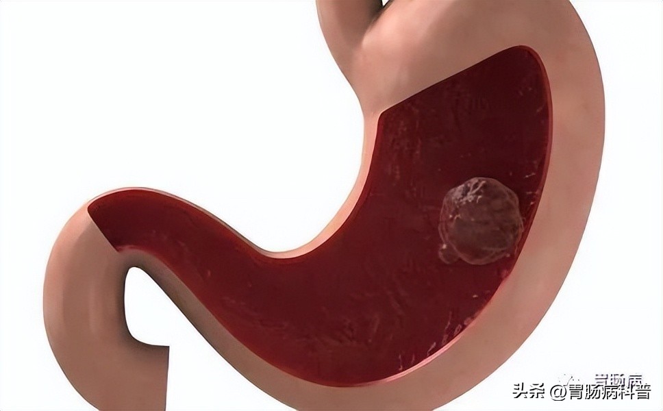 胃息肉切除多久能正常吃饭,胃息肉切除伤口多久能愈合