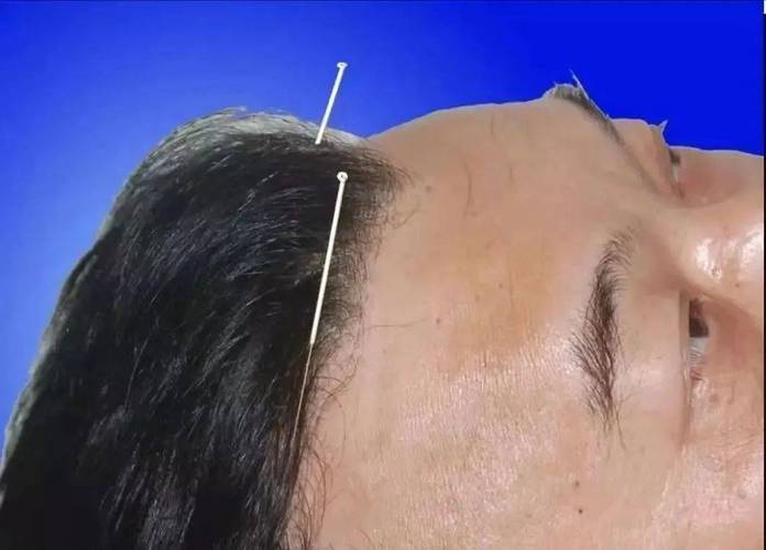 中医扎针治疗偏头痛,夹脊脉冲电针疗法