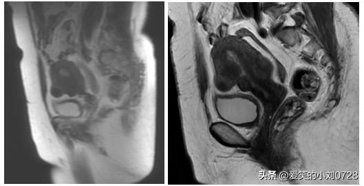 绝经后出血良性子宫瘤做什么手术,绝经后出血做宫腔镜查出内膜癌