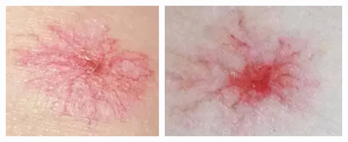 肚皮上长了个红痣是肝癌症状吗,身上有红痣是肝癌征兆吗