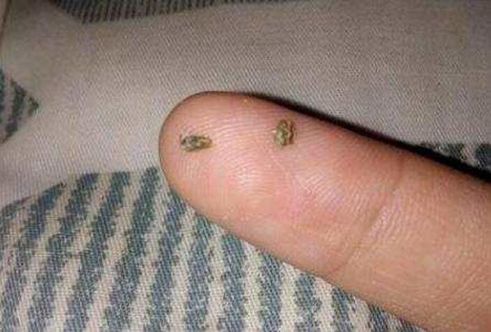 牙结石能直接抠下来吗,牙结石用手可以抠掉吗