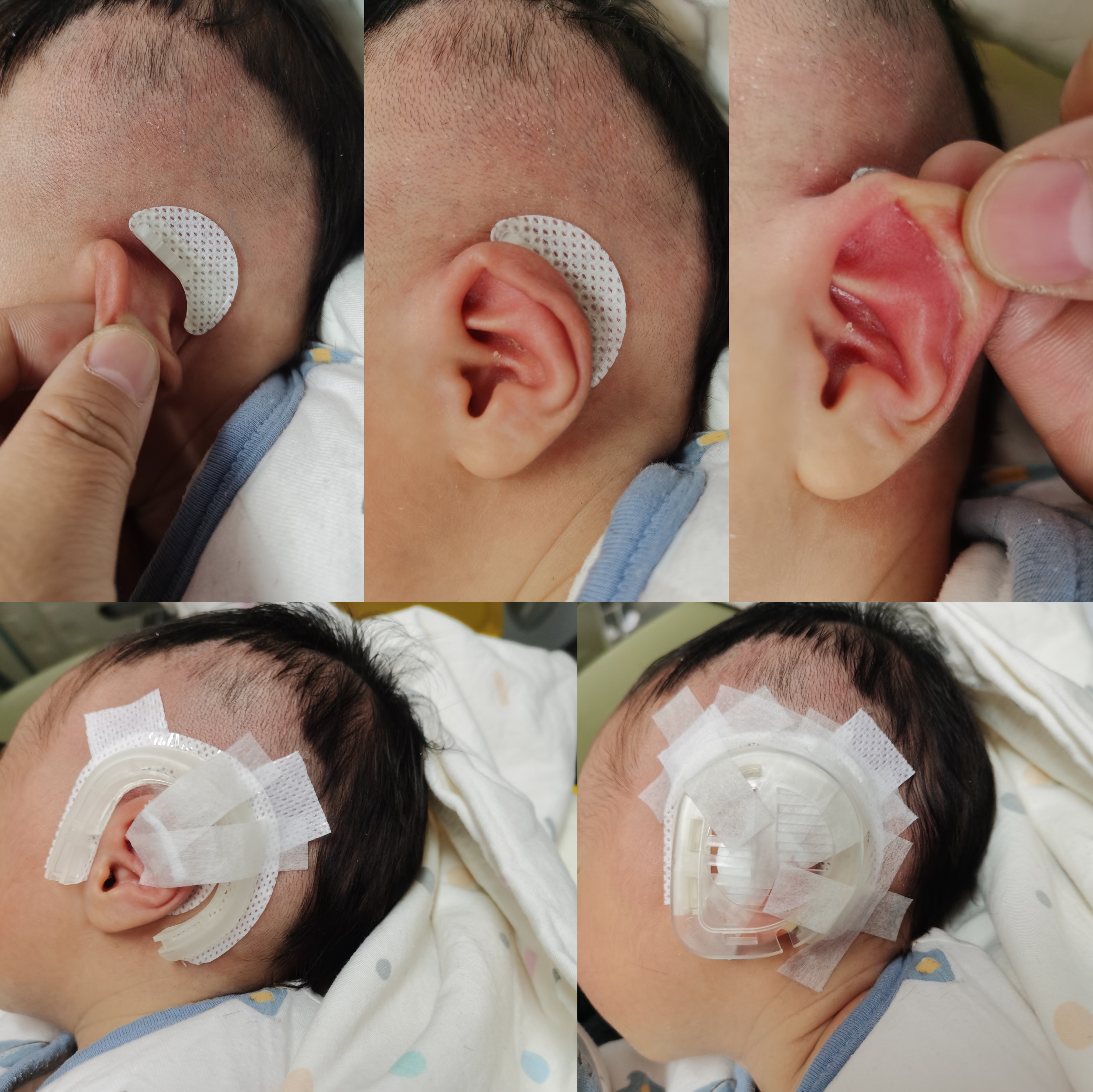 耳廓畸形九类畸形介绍,耳廓畸形一定伴有中耳畸形吗