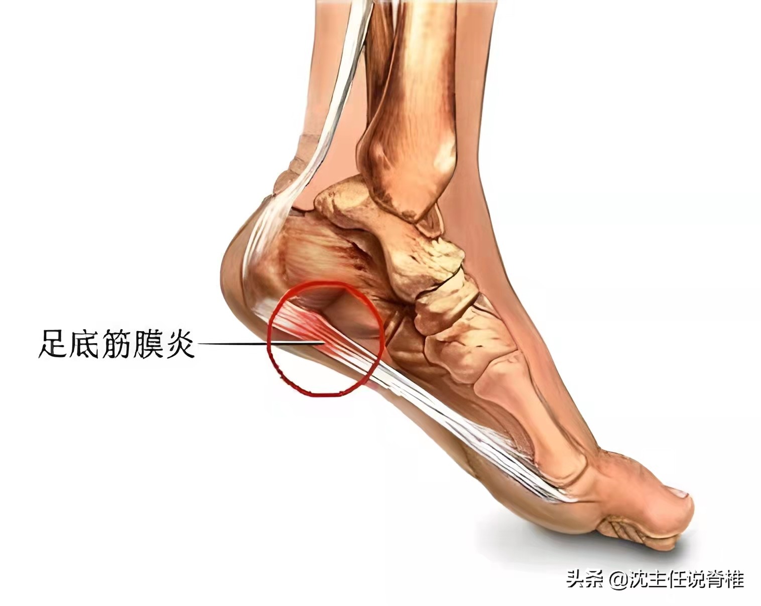 脚后跟痛有什么治疗方法与秘方,脚后跟疼不用慌专家教你一招解决