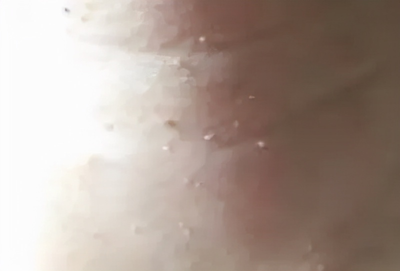 怀孕后脖子、身上长满了一粒粒小疙瘩，会传染吗？