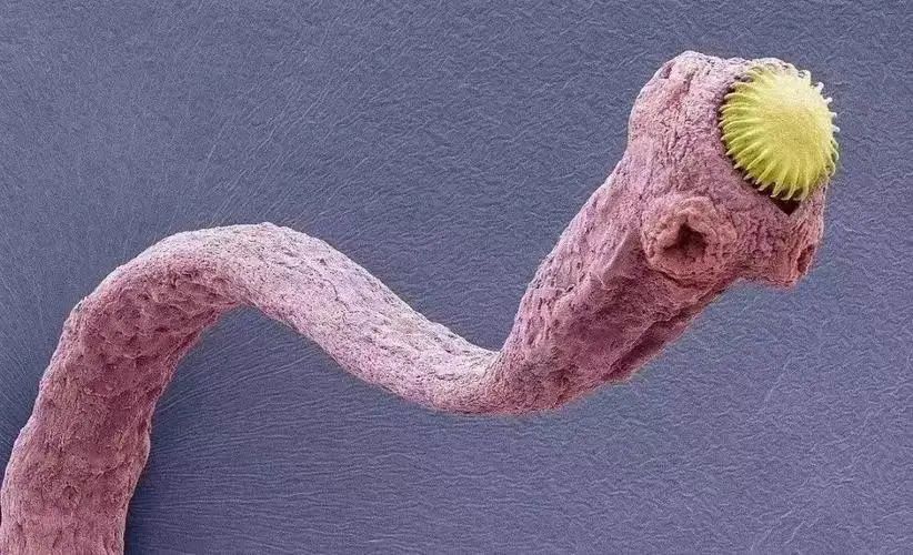 门医技术|区医院普通外科微创手术之腹腔镜“肝囊肿”开窗引流术