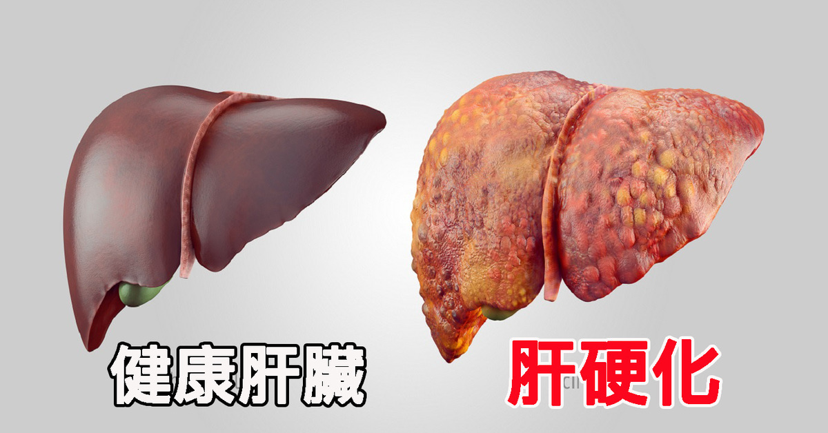 肝硬化代偿期手臂有小红点脂肪粒,肝硬化出现小红点可以自己消失吗