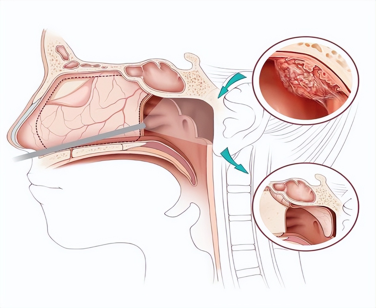 恶性肿瘤患者放疗期间吃点什么好,恶性肿瘤放疗后的注意事项