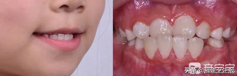 孩子牙齿地包天必须要矫正吗,孩子牙齿地包天需要矫正疼吗
